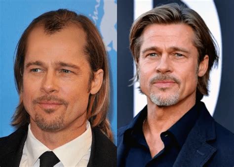 Male Celebrities Who Wear Toupees and Wigs Due to Hair Loss